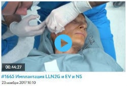Обучающие видео по имплантации нитей Light Lift Needle 2G