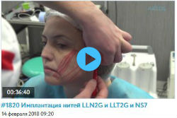 Обучающие видео по имплантации нитей Light Lift Needle 2G