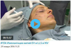 Обучающих видео по имплантации нитей Nano Vitis