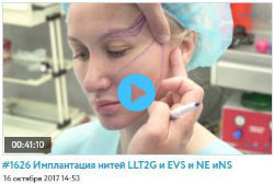 Обучающие видео по имплантации нитей Nano Spring