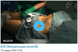 Обучающие видео по имплантации нитей Excellence Body